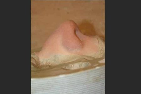 3D Prosthetic ‘Bondo’ Transfers